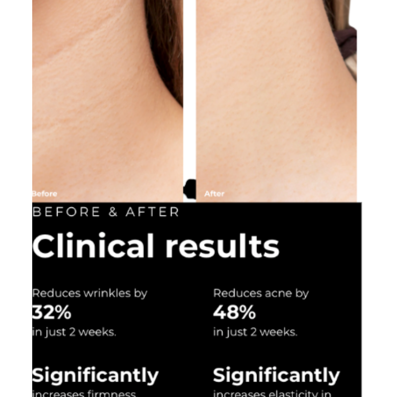 A side-by-side before and after skin progress comparison photo of a woman's neck, showing a visible reduction in horizontal lines and creases next to an official clinical results graphic stating a thirty-two percent reduction in wrinkles and a forty-eight percent reduction in acne in two weeks